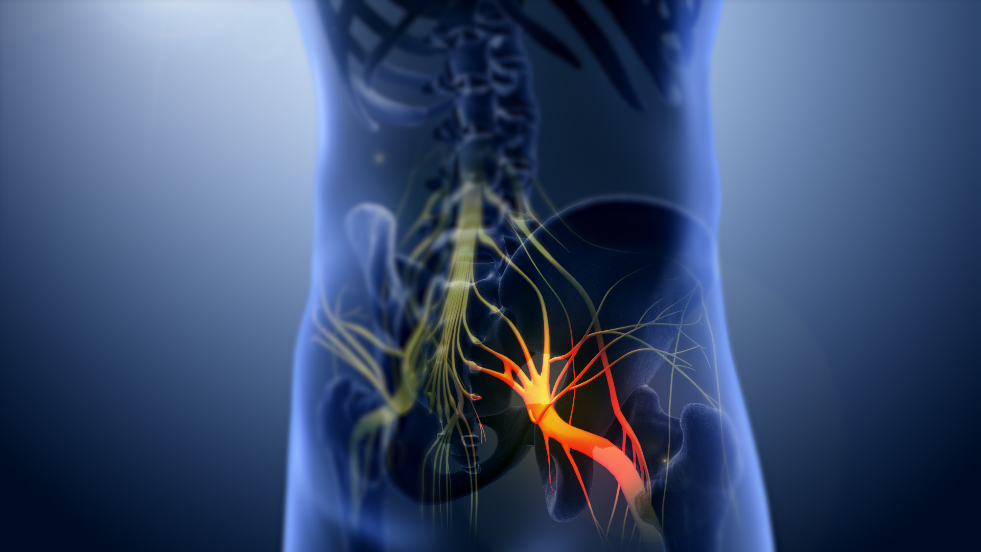 3D medical illustration showing sciatic nerve compression beginning at the lower spine